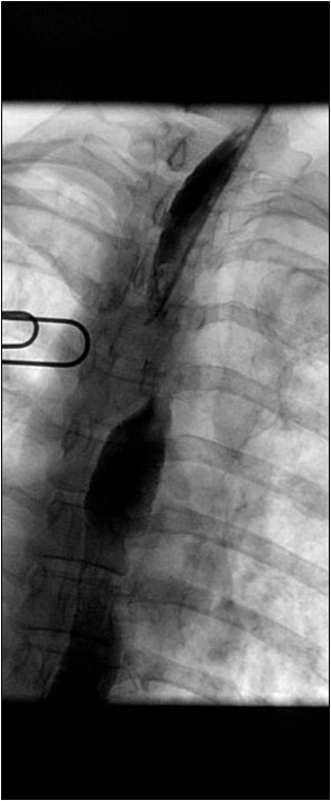 Nodal compression (unknown primary). Managing liquids.
